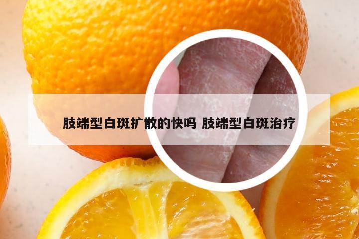 肢端型白斑扩散的快吗 肢端型白斑治疗