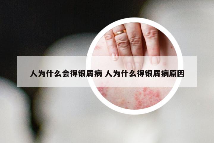 人为什么会得银屑病 人为什么得银屑病原因