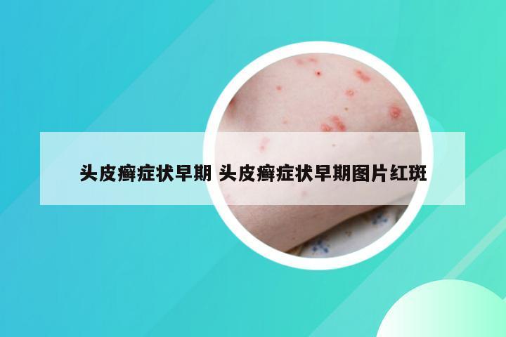 头皮癣症状早期 头皮癣症状早期图片红斑