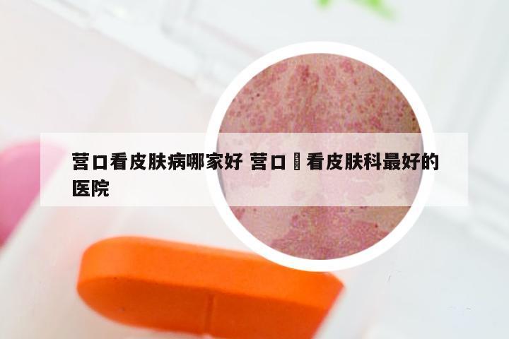 营口看皮肤病哪家好 营口巿看皮肤科最好的医院