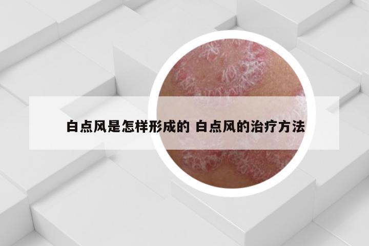 白点风是怎样形成的 白点风的治疗方法