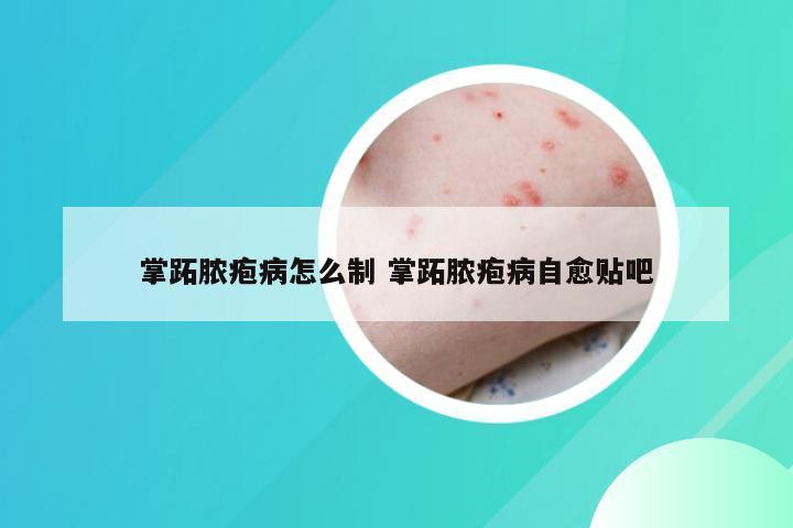 掌跖脓疱病怎么制 掌跖脓疱病自愈贴吧
