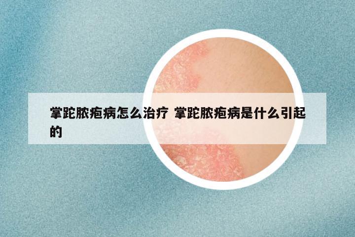 掌跎脓疱病怎么治疗 掌跎脓疱病是什么引起的