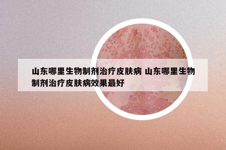 山东哪里生物制剂治疗皮肤病 山东哪里生物制剂治疗皮肤病效果最好