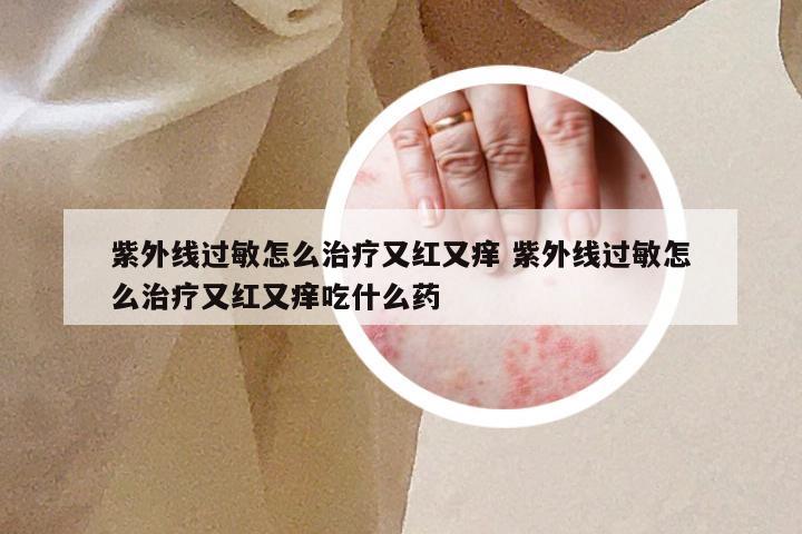 紫外线过敏怎么治疗又红又痒 紫外线过敏怎么治疗又红又痒吃什么药