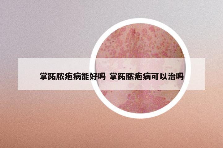掌跖脓疱病能好吗 掌跖脓疱病可以治吗