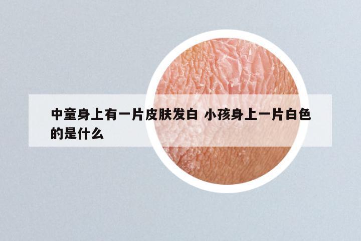 中童身上有一片皮肤发白 小孩身上一片白色的是什么