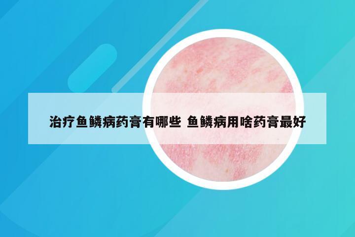 治疗鱼鳞病药膏有哪些 鱼鳞病用啥药膏最好