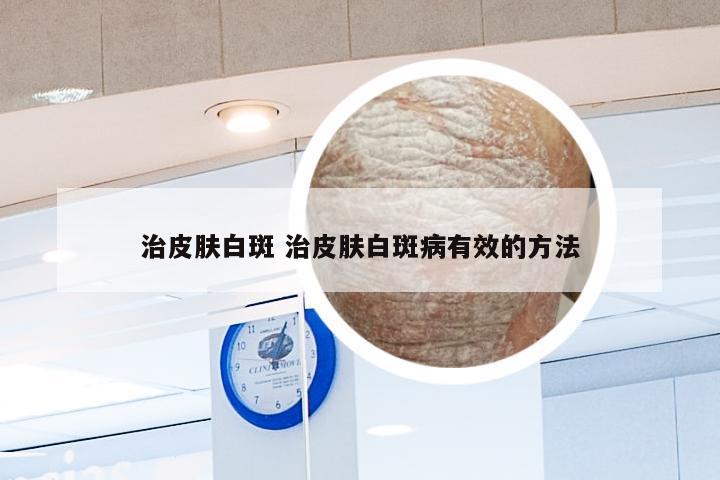 治皮肤白斑 治皮肤白斑病有效的方法