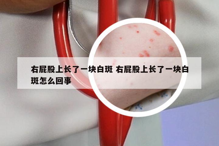 右屁股上长了一块白斑 右屁股上长了一块白斑怎么回事