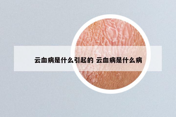 云血病是什么引起的 云血病是什么病
