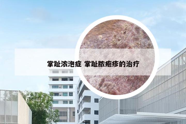 掌趾浓泡症 掌趾脓疱疹的治疗