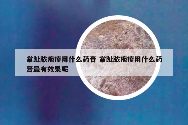 掌趾脓疱疹用什么药膏 掌趾脓疱疹用什么药膏最有效果呢