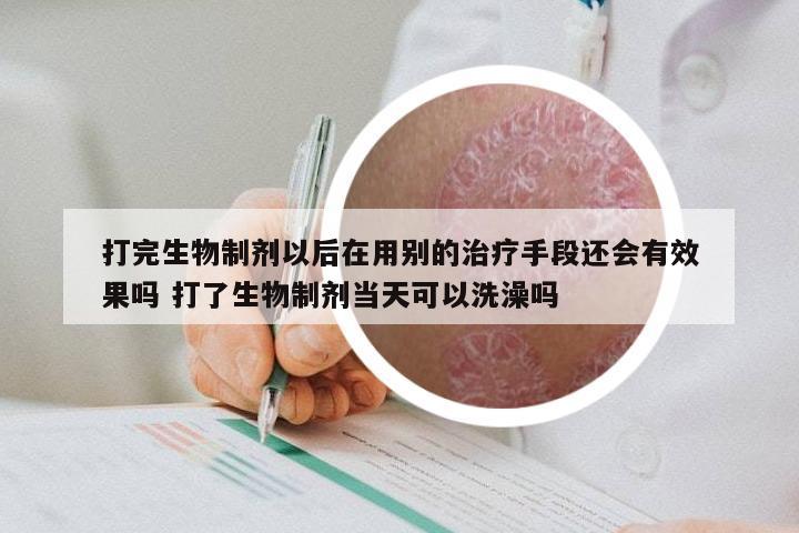 打完生物制剂以后在用别的治疗手段还会有效果吗 打了生物制剂当天可以洗澡吗