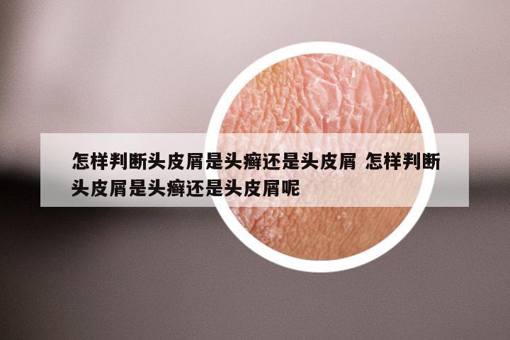 怎样判断头皮屑是头癣还是头皮屑 怎样判断头皮屑是头癣还是头皮屑呢