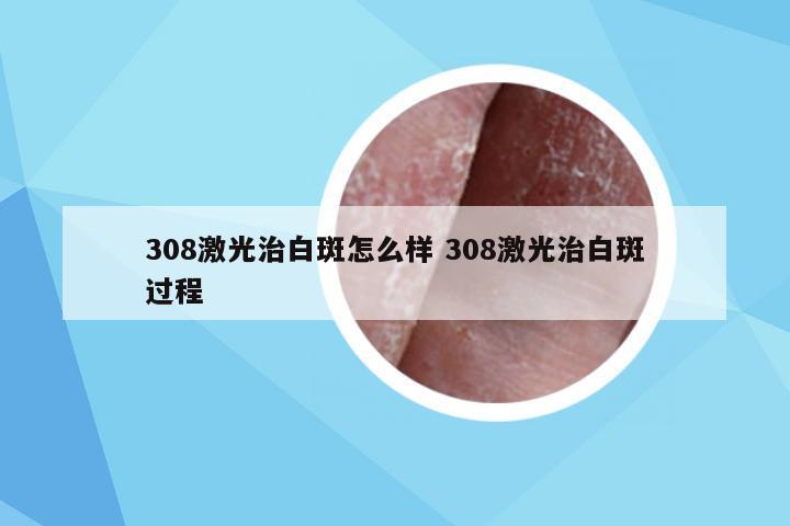 308激光治白斑怎么样 308激光治白斑过程