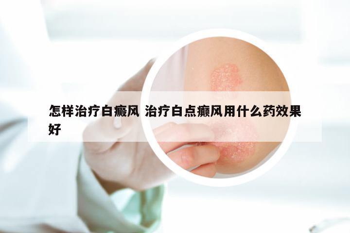 怎样治疗白癜风 治疗白点癫风用什么药效果好