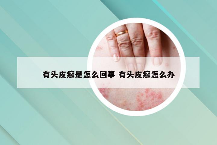 有头皮癣是怎么回事 有头皮癣怎么办