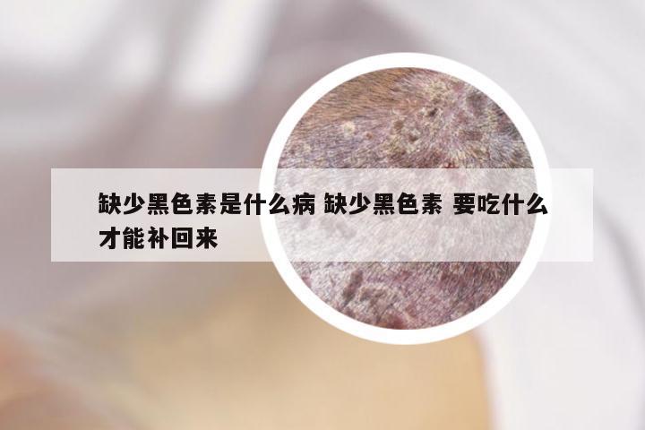 缺少黑色素是什么病 缺少黑色素 要吃什么才能补回来