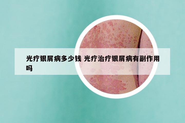 光疗银屑病多少钱 光疗治疗银屑病有副作用吗