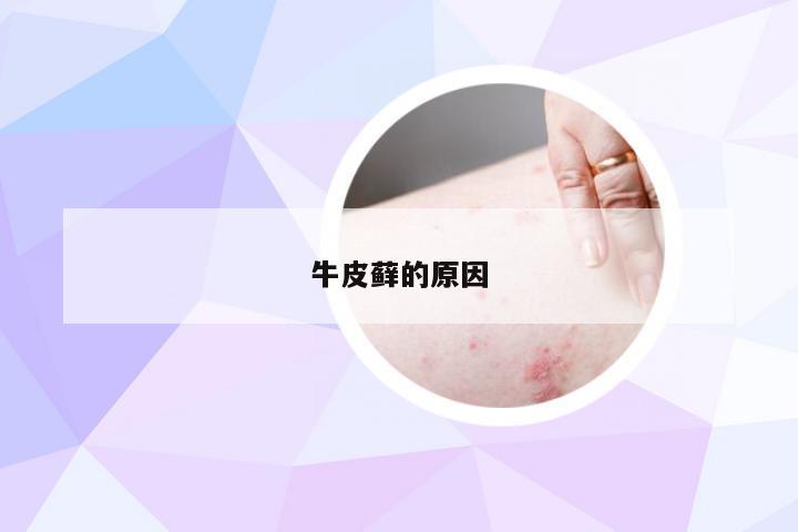 牛皮藓的原因