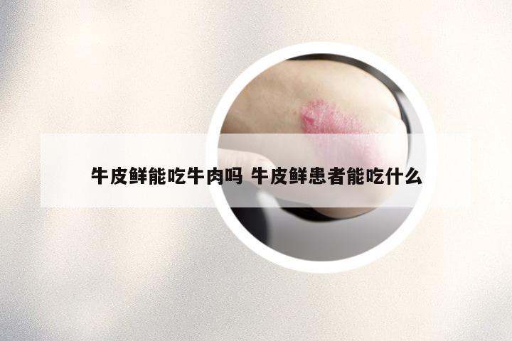 牛皮鲜能吃牛肉吗 牛皮鲜患者能吃什么