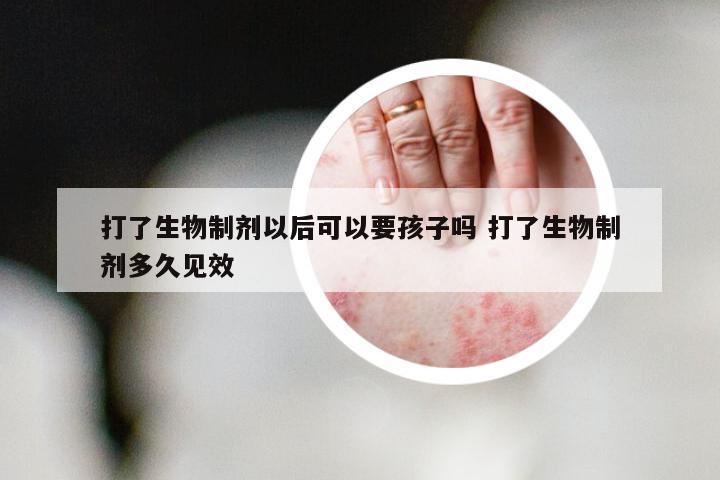 打了生物制剂以后可以要孩子吗 打了生物制剂多久见效