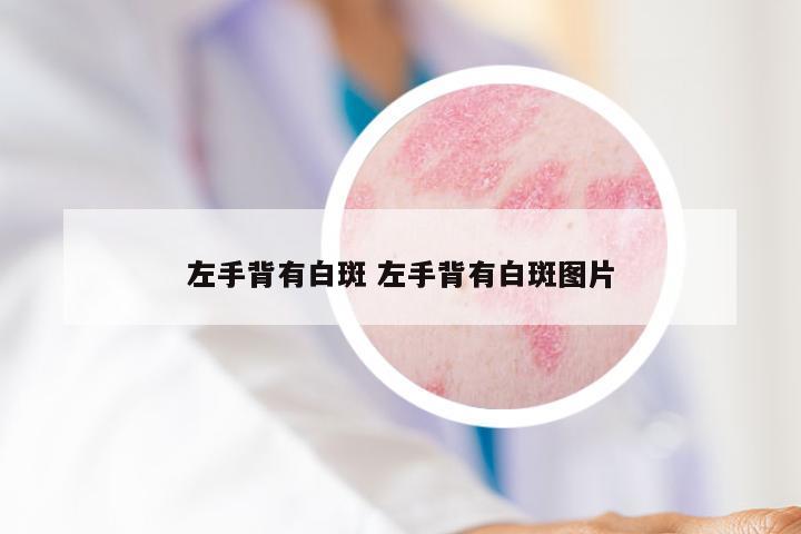 左手背有白斑 左手背有白斑图片