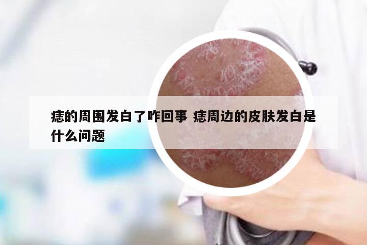 痣的周围发白了咋回事 痣周边的皮肤发白是什么问题