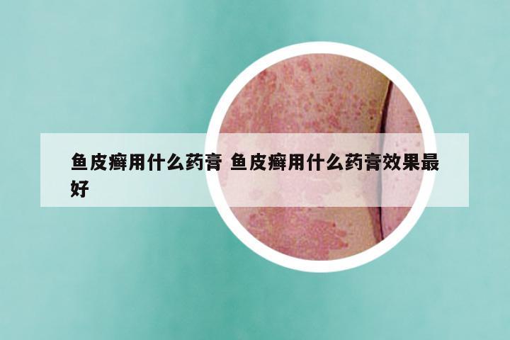 鱼皮癣用什么药膏 鱼皮癣用什么药膏效果最好