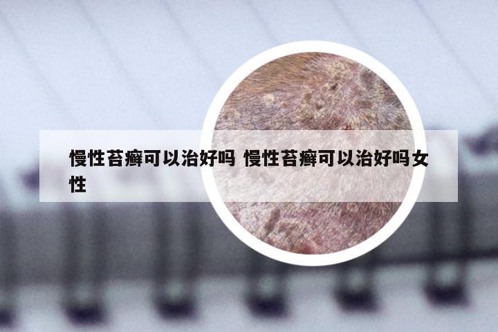 慢性苔癣可以治好吗 慢性苔癣可以治好吗女性