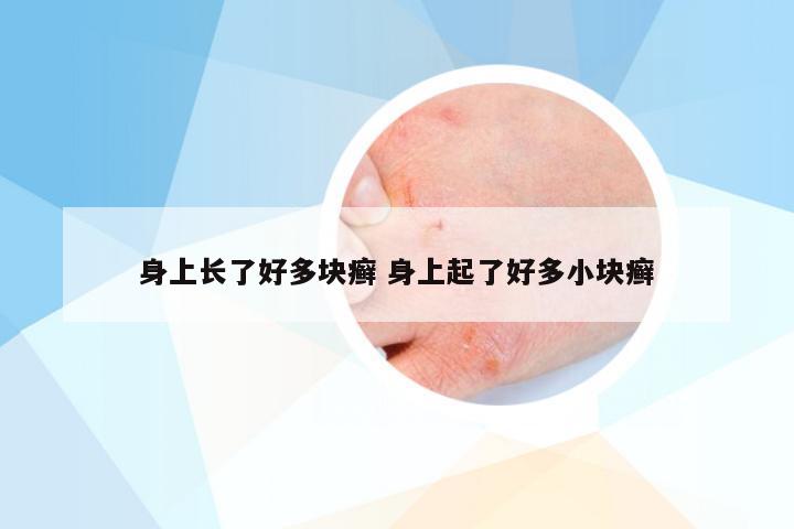 身上长了好多块癣 身上起了好多小块癣