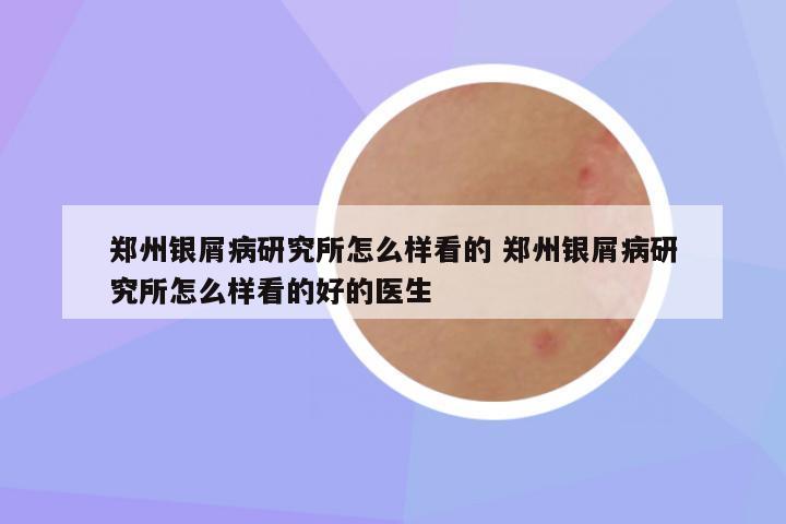 郑州银屑病研究所怎么样看的 郑州银屑病研究所怎么样看的好的医生