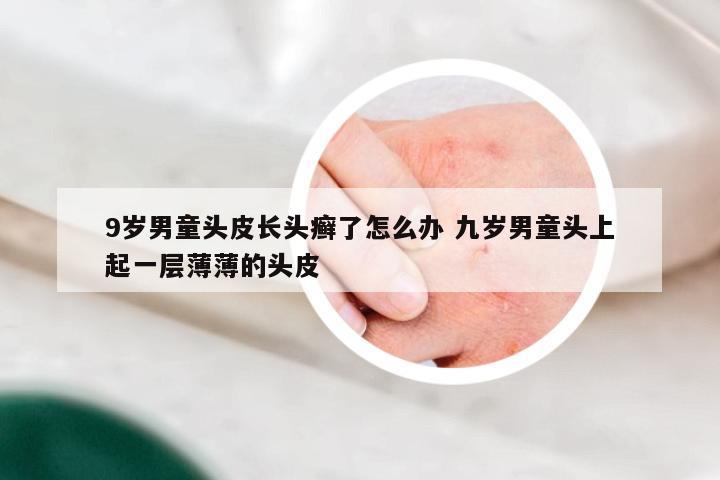 9岁男童头皮长头癣了怎么办 九岁男童头上起一层薄薄的头皮