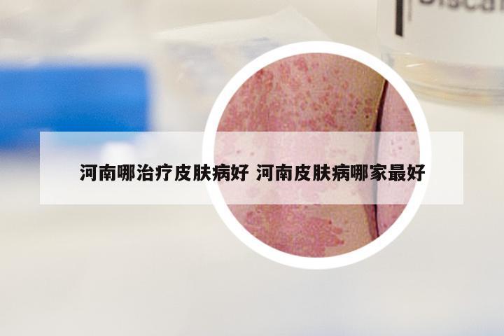 河南哪治疗皮肤病好 河南皮肤病哪家最好