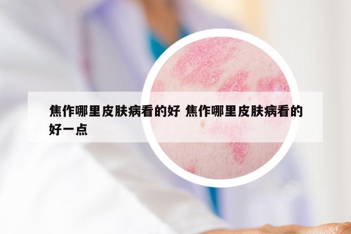 焦作哪里皮肤病看的好 焦作哪里皮肤病看的好一点