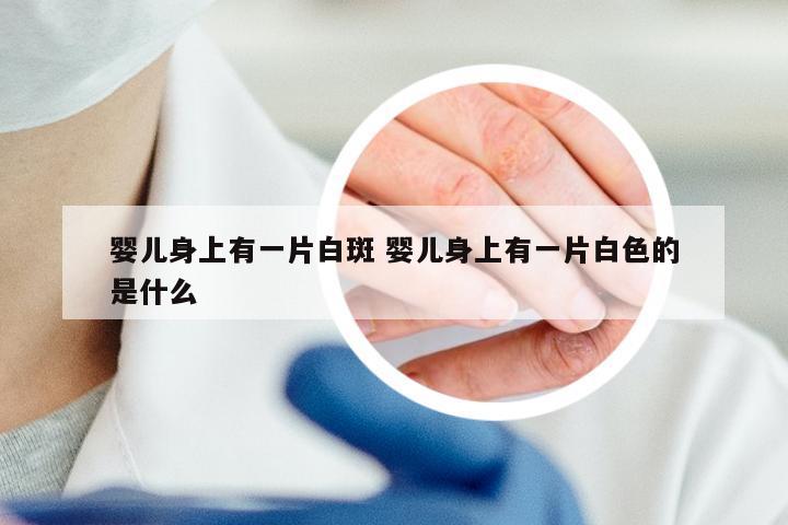 婴儿身上有一片白斑 婴儿身上有一片白色的是什么