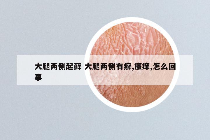 大腿两侧起藓 大腿两侧有癣,瘙痒,怎么回事