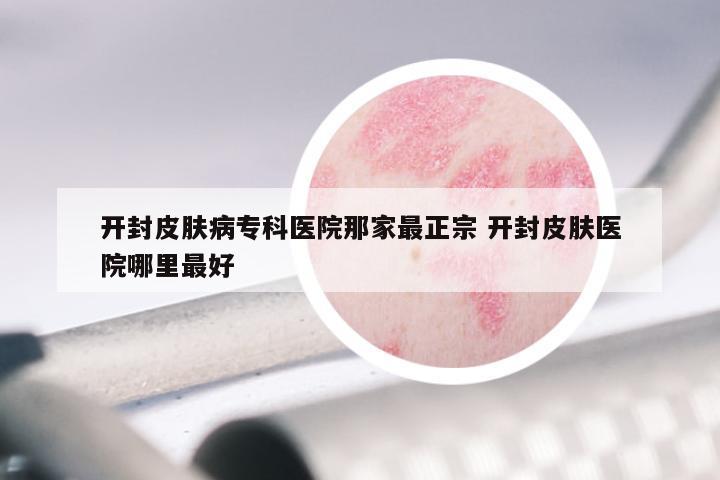 开封皮肤病专科医院那家最正宗 开封皮肤医院哪里最好