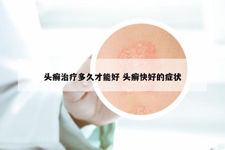 头癣治疗多久才能好 头癣快好的症状