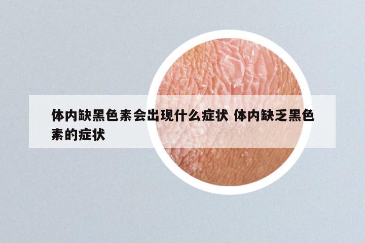 体内缺黑色素会出现什么症状 体内缺乏黑色素的症状