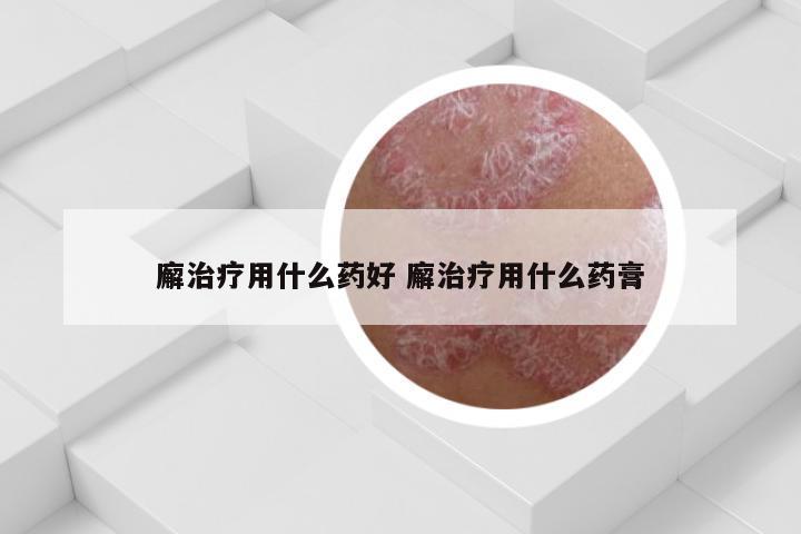廨治疗用什么药好 廨治疗用什么药膏
