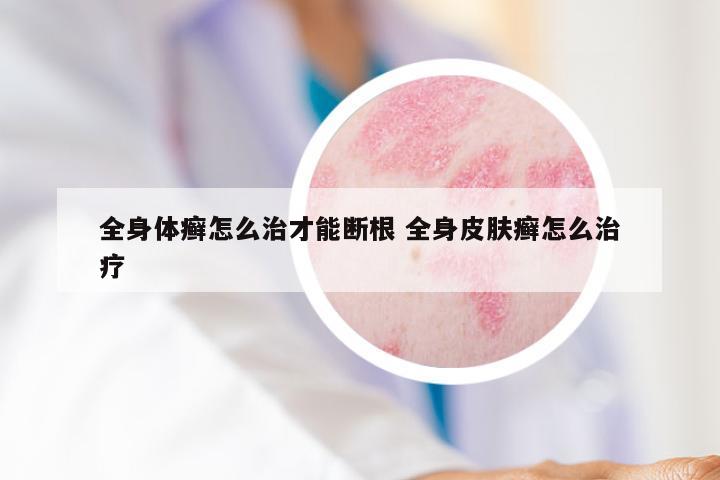 全身体癣怎么治才能断根 全身皮肤癣怎么治疗
