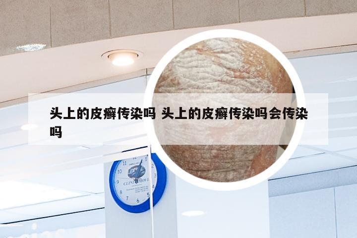 头上的皮癣传染吗 头上的皮癣传染吗会传染吗