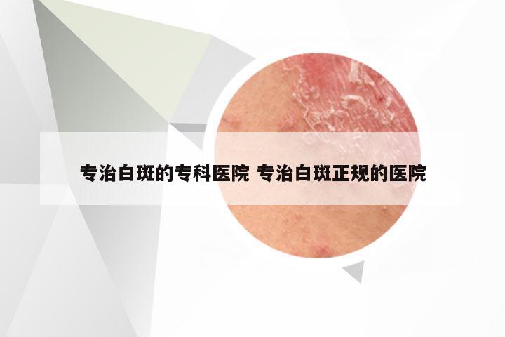 专治白斑的专科医院 专治白斑正规的医院