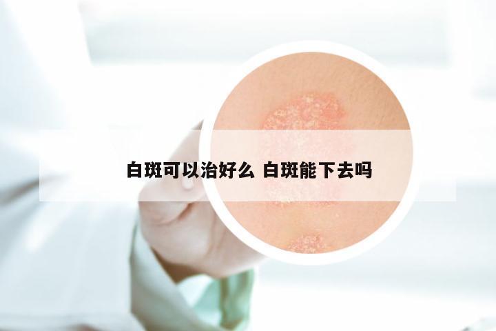 白斑可以治好么 白斑能下去吗