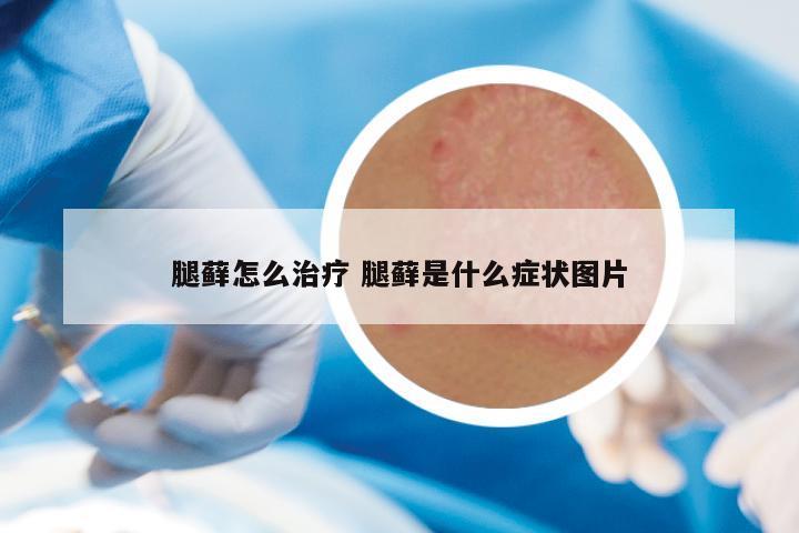 腿藓怎么治疗 腿藓是什么症状图片