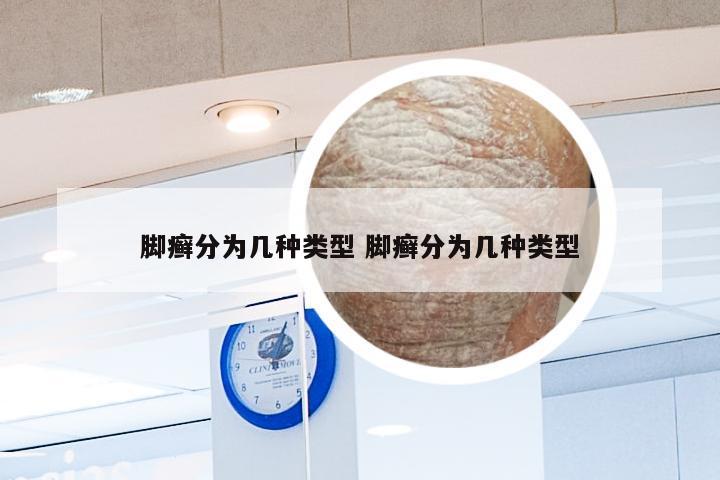 脚癣分为几种类型 脚癣分为几种类型