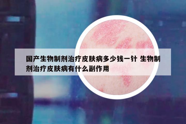 国产生物制剂治疗皮肤病多少钱一针 生物制剂治疗皮肤病有什么副作用