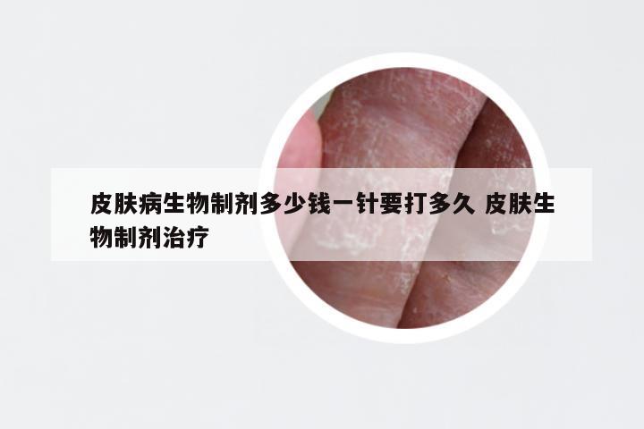 皮肤病生物制剂多少钱一针要打多久 皮肤生物制剂治疗